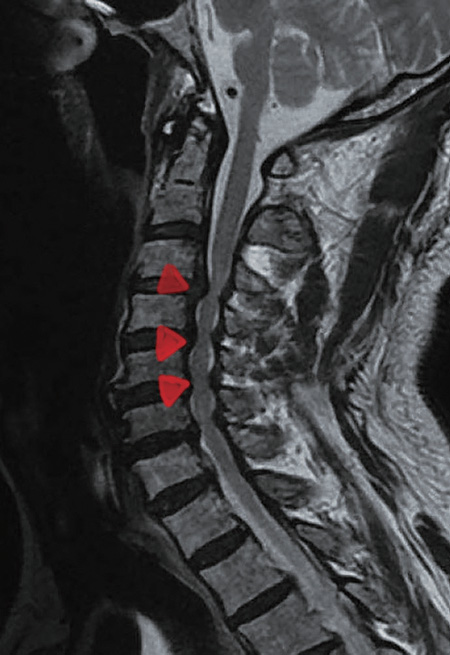 °æÃßô¼öÁõ ȯÀÚÀÇ MRI »çÁø